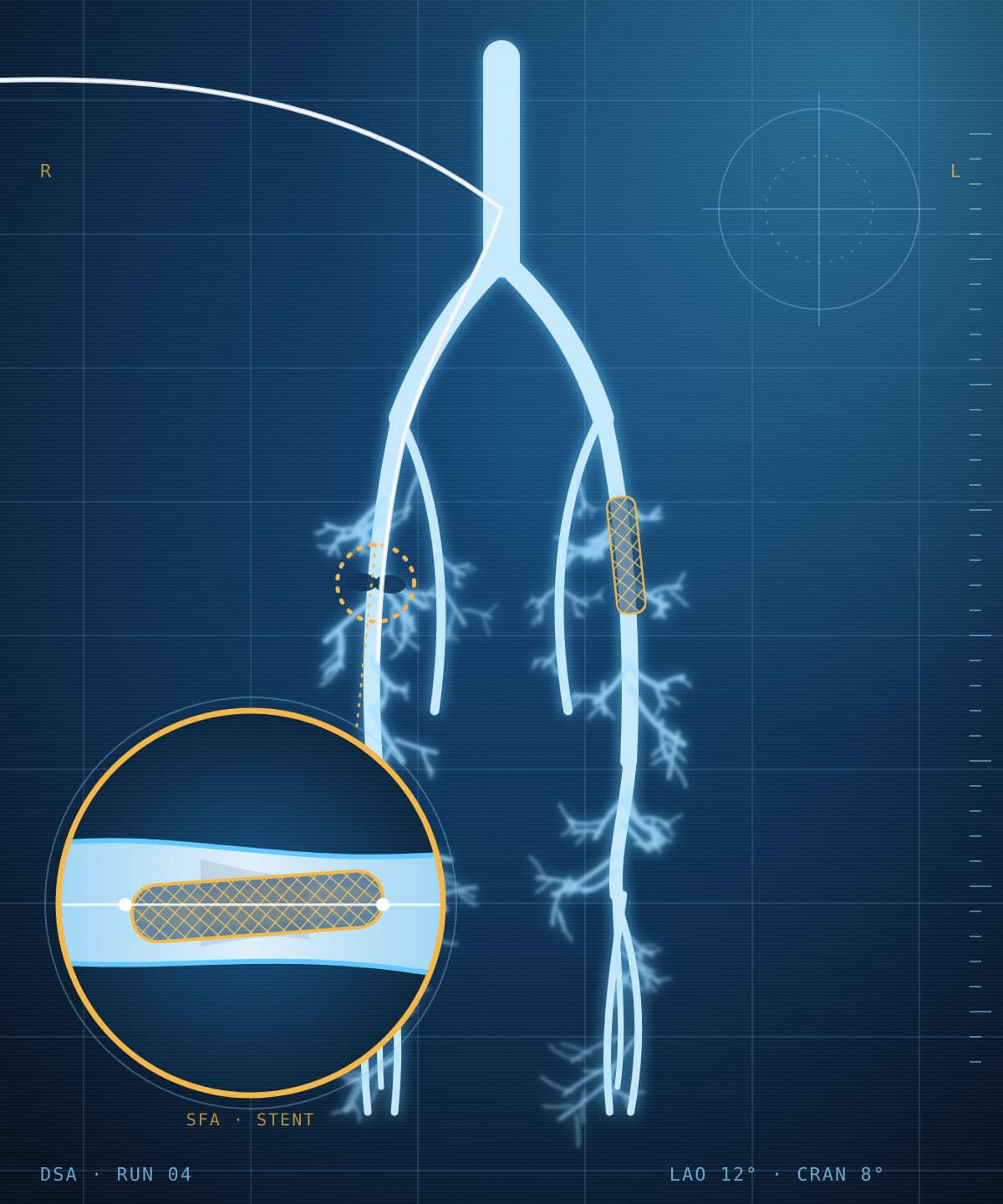 An angiogram of the arteries of both legs on a monitor, with a stenosis circled, a stent in the superficial femoral artery and a magnified view of the stent